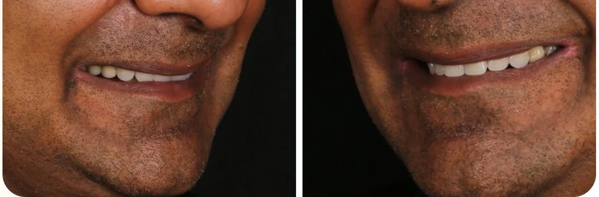 Sau điều trị: nụ cười của khách hàng Hetal Pandya ở hai góc chụp sau khi phục hình Implant