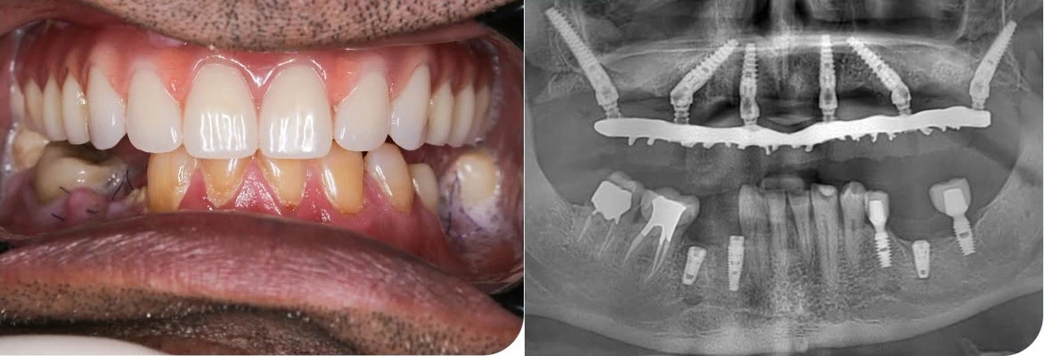 Sau điều trị: ảnh trong miệng và phim X-quang của khách hàng Hetal Pandya với phục hình All-on-6 hàm trên và 3 trụ Implant đơn lẻ hàm dưới