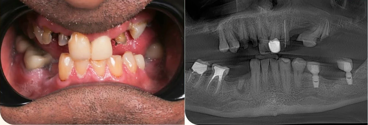 Trước điều trị: ảnh trong miệng và phim X-quang toàn cảnh của khách hàng Hetal Pandya, cho thấy tình trạng mất nhiều răng