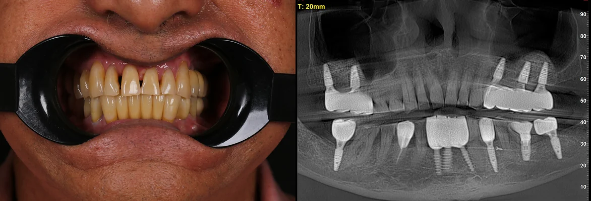 Sau điều trị: ảnh trong miệng và phim X-quang của chú Philippe Tanguy sau khi cấy 8 trụ Implant đơn lẻ, giữ lại răng thật còn khỏe