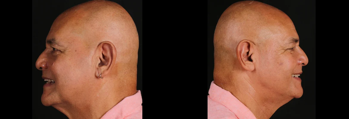 Sau điều trị: chú Philippe Tanguy ở hai góc nghiêng sau khi phục hình Implant