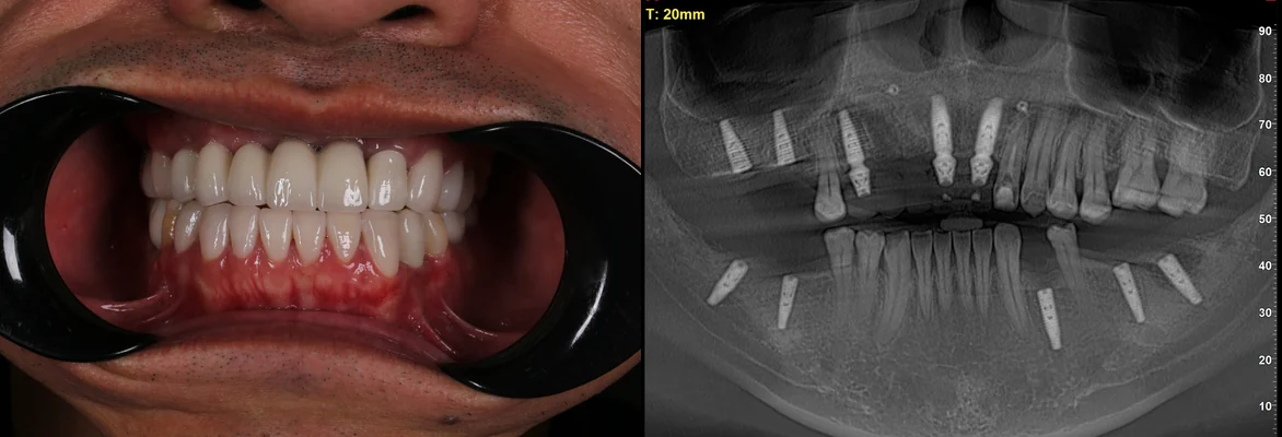 Sau điều trị: ảnh trong miệng và phim X-quang của anh Nguyễn Chí Hiếu sau khi cấy Implant và phục hình các răng đã mất