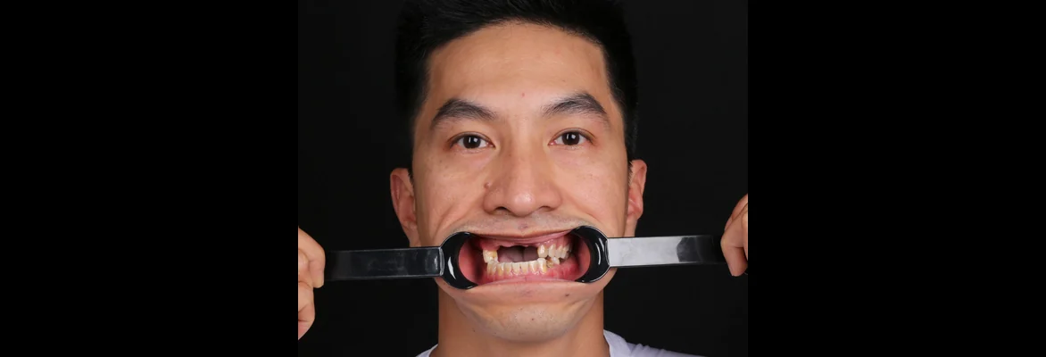 Trước điều trị: gương mặt anh Nguyễn Chí Hiếu, banh miệng thấy rõ các vị trí mất răng