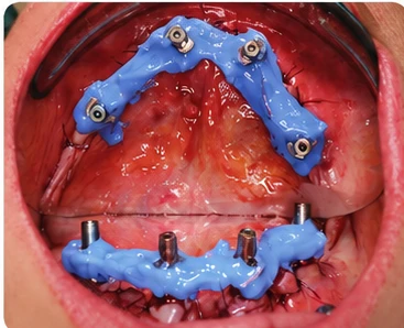 Đặt trụ Implant toàn hàm