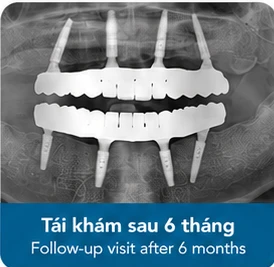 Tái khám đánh giá tích hợp xương